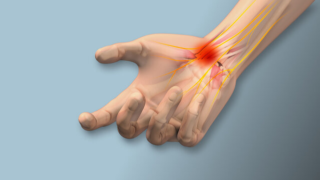  Carpal tunnel syndrome pain, numbness,tingling 
