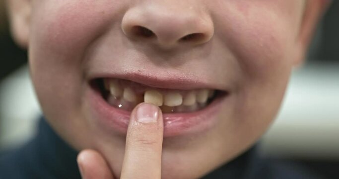 Kid Boy Shows Wobbly Loose Milk Baby Tooth. Child Wobbling Tooth with Hand Fingers. 4K 10-bit