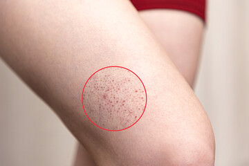 Woman's leg in close-up, with red rash. Hip with allergies and Irritation. Concept of dermatology...