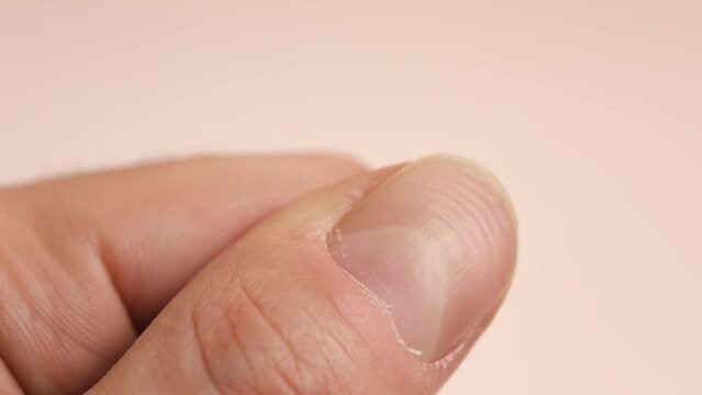 Ridged fingernails with vertical and horizontal ridges. Nails problems
