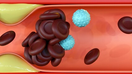 3d rendering of plaque formation of Cholesterol in artery (atherosclerosis) and hemagglutinated blood
