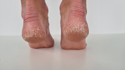 Female feet with cracks and peeling on heels isolated on a white background. Fungal skin...