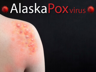 Alaskapox virus. Human skin is blistered by the Alaskapox virus. Virus, epidemic, disease. Model of a dangerous flying virus, bacteria, microbe. Black background.