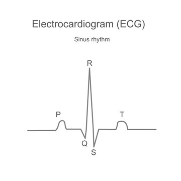 The diagram of Electrocardiogram (ECG) or Electrocardiography (EKG) that reads is a typical sinus rhythm.