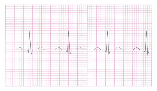 The picture of Electrocardiogram (ECG) or Electrocardiography (EKG) that plotted the curve on a graph paper to check up the heartbeat.