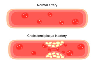 Obraz premium Normal blood vessels artery and cholesterol plaque in artery for heart disease 