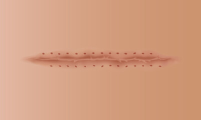 Healing wounds, skin scar, stitched gash and cut. Realistic surgical suture, stitched wounds. Healing stage on human skin background. Vector illustration