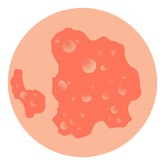 Type of psoriasis vector. Part of patients skin with dermatitis, inflammation, red rash and other skin problems. Cartoon illustration for disease concept