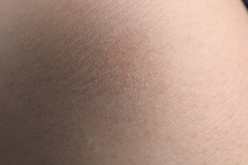 Closeup view of woman with dry skin