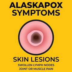 Vector illustration of Alaskapox symptoms with damaged skin close up - 734567798