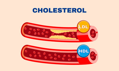 Normal blood flow, accumulation of cholesterol in blood vessels with HDL and LDL lipoproteins of normal arteries and narrowed arteries. Vector illustration
