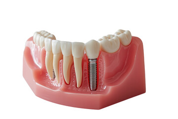dental model featuring multiple implants, demonstrating various tooth replacement options.
