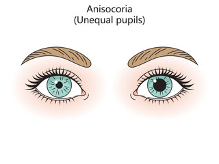 Human eyes with anisocoria diagram hand drawn schematic raster illustration. Medical science educational illustration