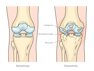 Human Osteoarthritis Rheumatoid arthritis of knee joint structure diagram hand drawn schematic raster illustration. Medical science educational illustration