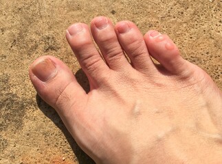 The friction blisters on the little toe. The vesicle on the skin of pinky toe.