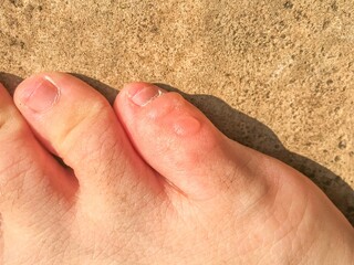 The friction blisters on the little toe. The vesicle on the skin of pinky toe.
