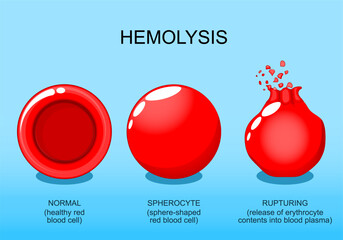 Hemolysis. Normal red blood cell, spherocyte, and rupturing of erythrocyte.