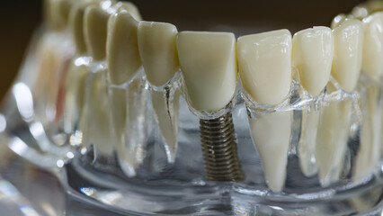 Dental implant, artificial tooth roots into jaw, root canal of dental treatment