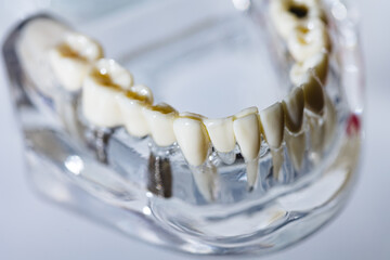 Dental implant, artificial tooth roots into jaw, root canal of dental treatment