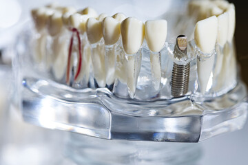 Fototapeta na wymiar Dental tooth implant titanium prosthetic dentists model.