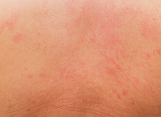 allergic rash on the body of the patient.