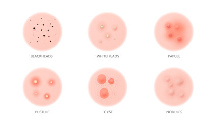 Acne types, body or face skin pimples and inflammation problems, vector icons. Acne types, blackhead, pustule or whitehead, papule and cyst with nodules for skincare beauty cosmetology and dermatology