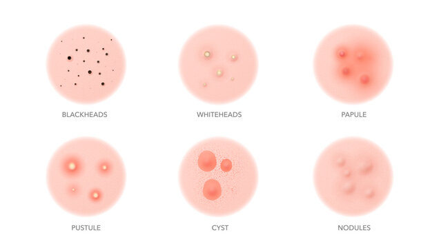 Acne types, body or face skin pimples and inflammation problems, vector icons. Acne types, blackhead, pustule or whitehead, papule and cyst with nodules for skincare beauty cosmetology and dermatology