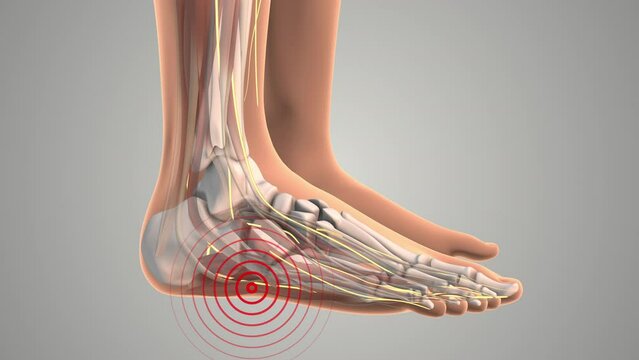 The Tarsal Tunnel Numbness in the Heel and Foot