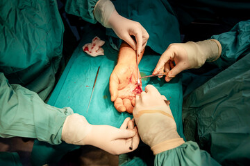Medical team, surgeons and assistants,  healthcare professionals, using sterile surgical instruments, hand surgery in hospital's operating room.