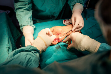 Medical team, surgeons and assistants,  healthcare professionals, using sterile surgical instruments, hand surgery in hospital's operating room.