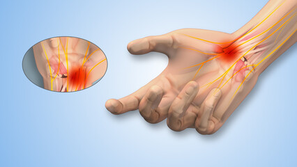 Carpal tunnel syndrome tingling and numbness in hand