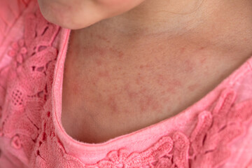 Singapore flu, skin rashes, blisters, viral infection, disease