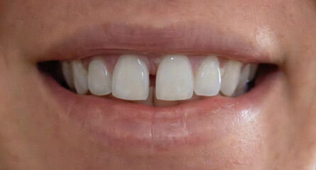 human smile with teeth with diastema