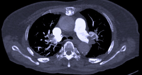 A CTA pulmonary artery reveals a detailed view of the lung blood vessels, capturing the presence of a pulmonary embolism, a condition where a blood clot disrupts normal blood flow.