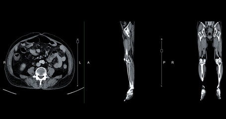 A CT venogram of the leg is a non-invasive imaging procedure offering detailed visuals of leg veins. - obrazy, fototapety, plakaty