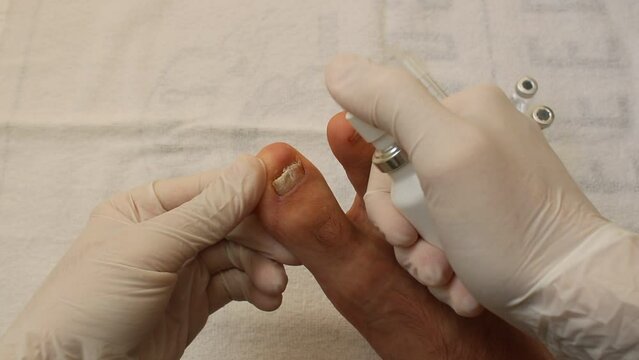 dermatologist who treats heel spur and athlete's foot with herbal cream. Bloody toenail treatment.	