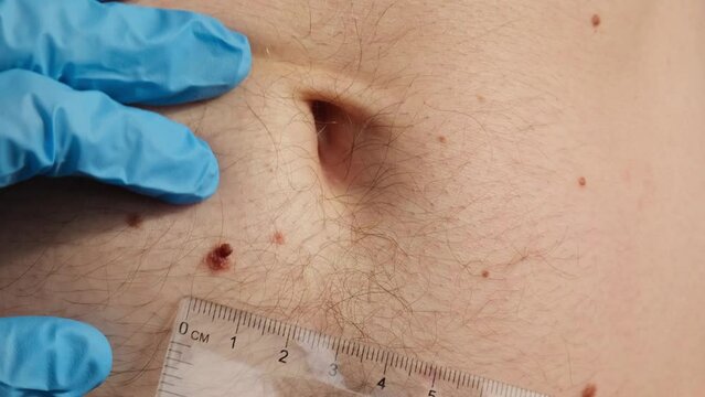 Dermatologist checking male birthmarks with ruler. Doctor examining length and width of benign moles on man skin Pigmentation. 