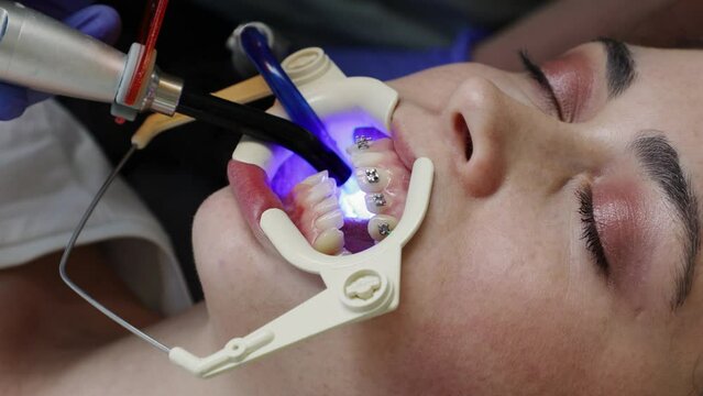 Orthodontist fixes ligature braces on teeth of young woman. Close up of Caucasian woman at appointment in dental clinic. Concept of dentistry and orthodontics