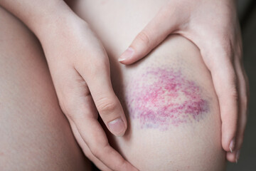Bruise. Contusion on the knee of a teenage girl. Close-up image of a girl sitting and holding an...