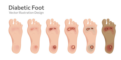 Diabetic foot different stages vector illustration. - obrazy, fototapety, plakaty
