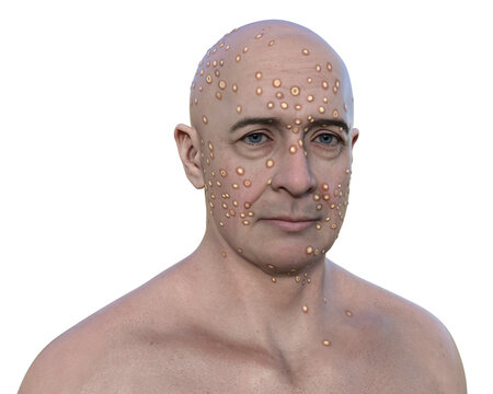 A man with rash from pox viruses, 3D illustration