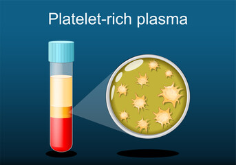 PRP. test tube with blood and platelet-rich plasma.