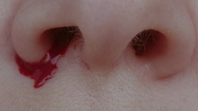 bright red blood flows from nostril, bright red blood flows from nostril, close-up part of face, fragility of blood vessels, heart diseases, sharp increase in blood pressure