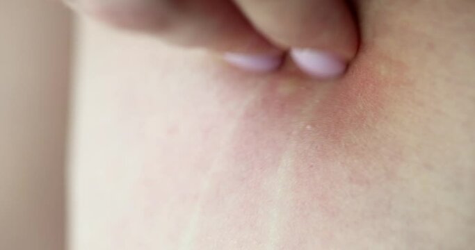 Hand scratching itchy skin rash after mosquito bite closeup 4k movie slow motion. Diagnosis and treatment of allergic diseases concept