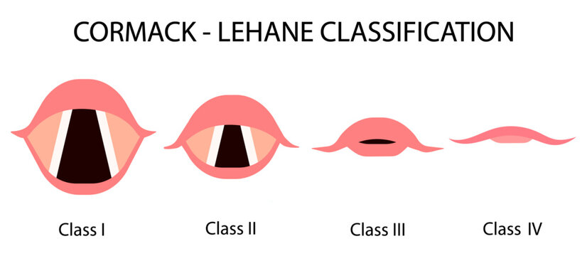 The Cormack–Lehane (CL) classification system classifies views obtained by direct laryngoscopy based on the structures seen. Medical procedure vector illustration isolated on white background.