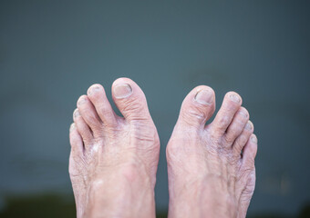 The feet and toes of elderly people have dry, wrinkled skin.
