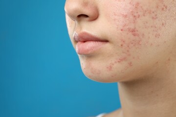 Teenage girl with acne problem on blue background, closeup