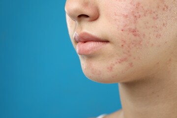 Obraz premium Teenage girl with acne problem on blue background, closeup