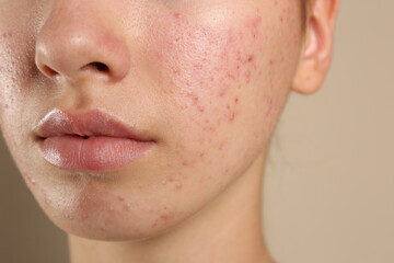 Teenage girl with acne problem on beige background, closeup