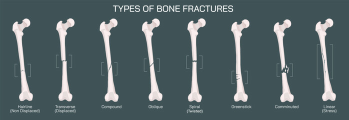 Types of bone fracture. Structure of a bone vector illustration. The quality or structure changes in marrow density. Build and strength of bone tissues. Stymptoms and stages and  growth. Bone anatomy.
